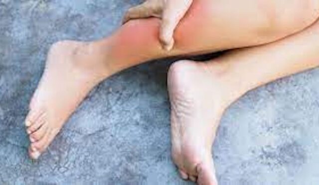 El ve ayaklarda şişkinlik görülmesi